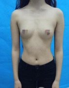 美国妙桃隆胸三个月让我的胸部重返少女状态 width=