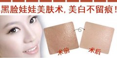 做黑脸娃娃一个疗程要多少钱? width=
