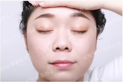 5S灵动重睑术
