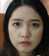 成都艺星硅胶垫鼻梁怎么自拍怎么好看 width=