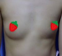 娜琦丽假体隆胸圆盘的好还是水珠的好?看下案列。 width=