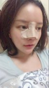 骨粉隆鼻后遗症有多大?骨粉隆鼻失败修复曲折的恢复之路 width=