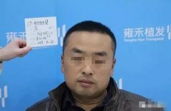 疤痕植发1100单位，4个月后的他大变样！ width=
