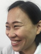 注射瘦脸去鱼尾纹能管多久我的亲身经历来告诉你 width=