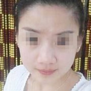 骨粉隆鼻后遗症我的经历告诉你注意一下几点避开后遗症 width=