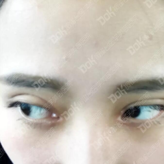 韩式翘睫双眼皮真实案例有吗?我妹也想做一个