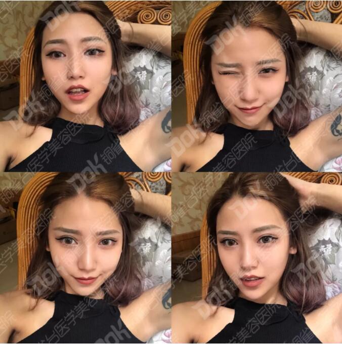 韩式翘睫双眼皮真实案例有吗?我妹也想做一个