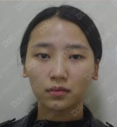 韩式翘睫双眼皮真实案例有吗?我妹也想做一个 width=