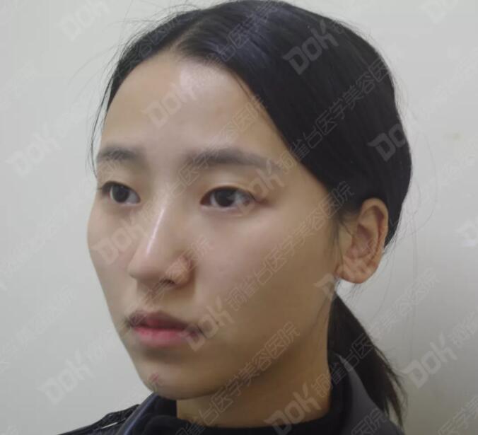 韩式翘睫双眼皮真实案例有吗?我妹也想做一个
