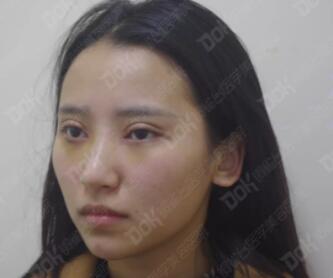 韩式翘睫双眼皮真实案例有吗?我妹也想做一个