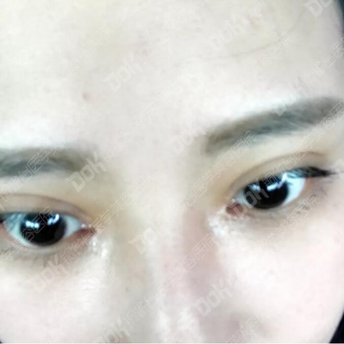 韩式翘睫双眼皮真实案例有吗?我妹也想做一个