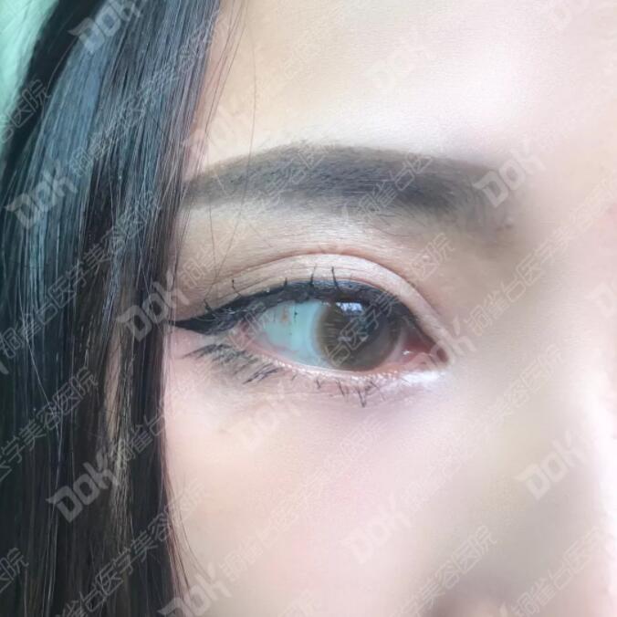 韩式翘睫双眼皮真实案例有吗?我妹也想做一个