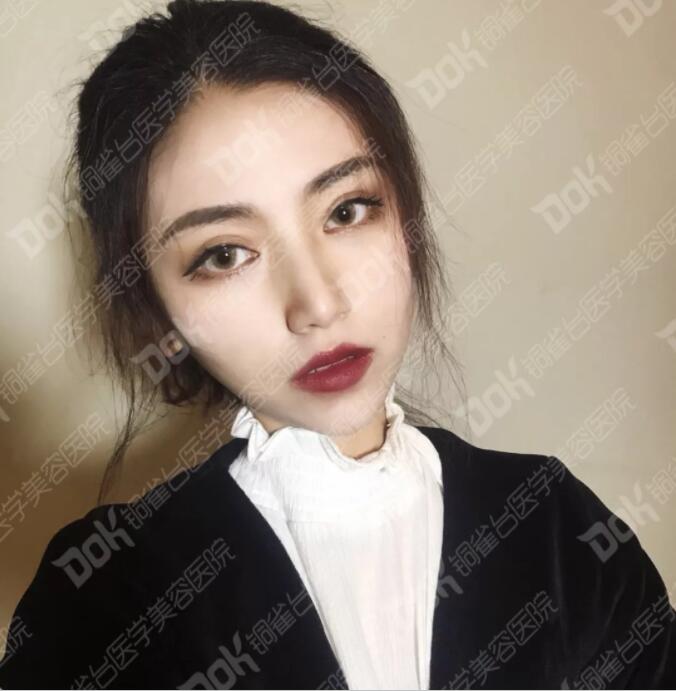 韩式翘睫双眼皮真实案例有吗?我妹也想做一个