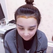 美人尖是什么样子的?来看看我的美人尖种植案例你就知道了 width=