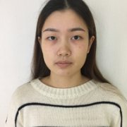 成都仪美整形两月前做的双眼皮还在恢复中，先看看恢复果吧 width=