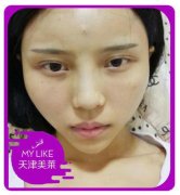 天津美莱磨颧骨前后对比图：68天可人儿的进击之路~ width=