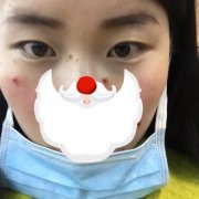 成都米亚整形医院才做不到一个月双眼皮恢复果图 width=