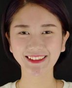在袁志杰医生手里做的美容冠看我的果如何 width=