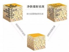 镭射净肤大概多少钱?小编带你了解影响因素 width=