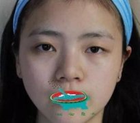 杭州格莱美美容医院怎么样?双眼皮整形案例告诉你! width=
