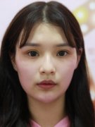 何祯平医生技术好吗？何祯平医生隆鼻案例分享~ width=