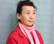 筋膜悬吊除皱案例|孙阿姨的筋膜悬吊除皱经历 width=