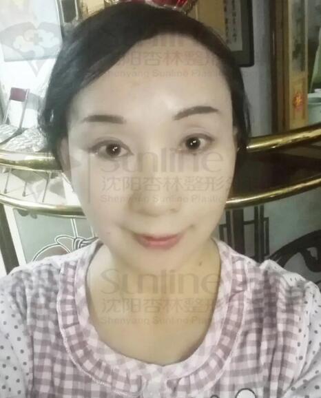 筋膜悬吊除皱