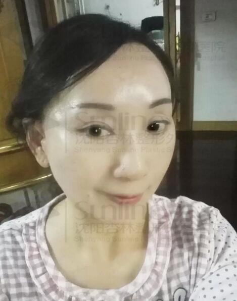 筋膜悬吊除皱
