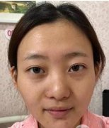 星团医疗整形美容综合隆鼻100天了，百分百的满意 width=