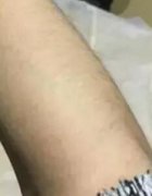成都铜雀台整形美容做了个冰点脱毛，这个夏天不在恐惧穿短袖短裙了~ width=