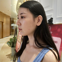 去颊脂垫果如何?成都铜雀台真实案例为大家分享