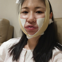 去颊脂垫果如何?成都铜雀台真实案例为大家分享