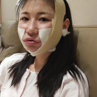 去颊脂垫果如何?成都铜雀台真实案例为大家分享