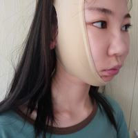 去颊脂垫果如何?成都铜雀台真实案例为大家分享