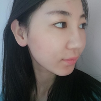 去颊脂垫果如何?成都铜雀台真实案例为大家分享