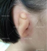 全耳再造手术分几期完成?我用我的实际情况来为你解答 width=
