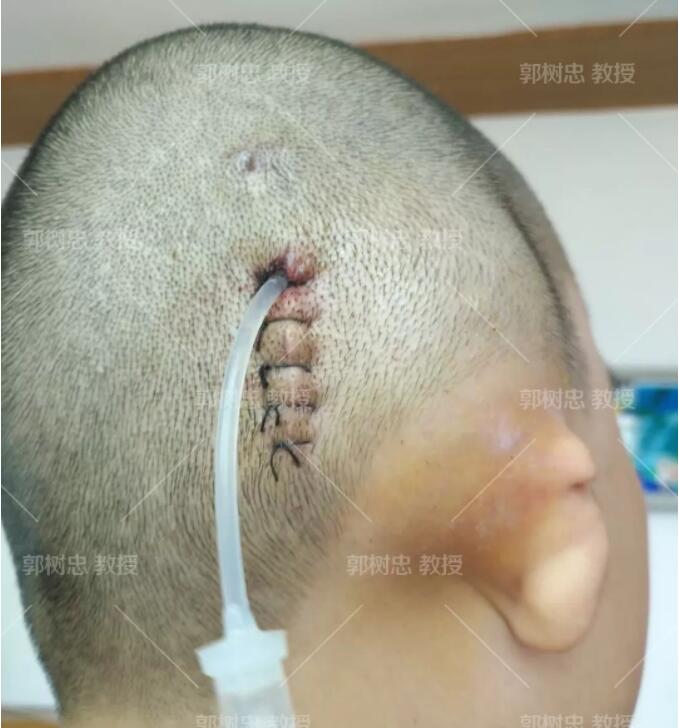 全耳再造手术分几期完成?我用我的实际情况来问你解答