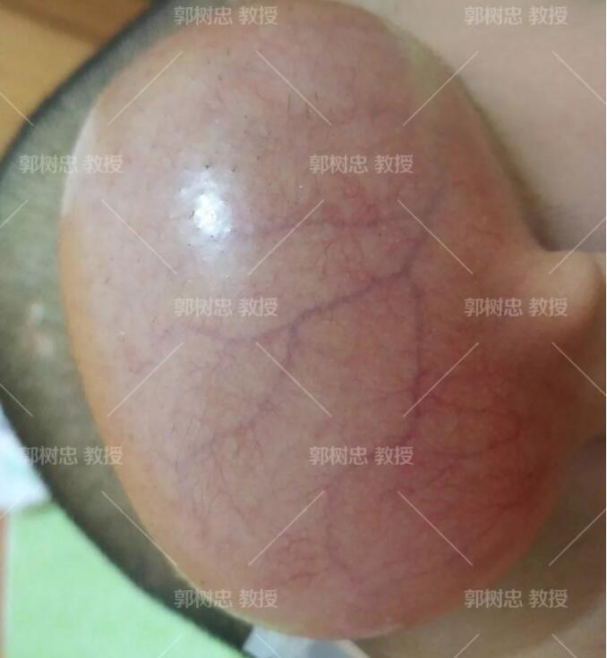 全耳再造手术分几期完成?我用我的实际情况来问你解答
