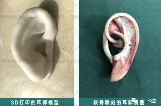 全耳再造手术分几期完成?我用我的实际情况来问你解答