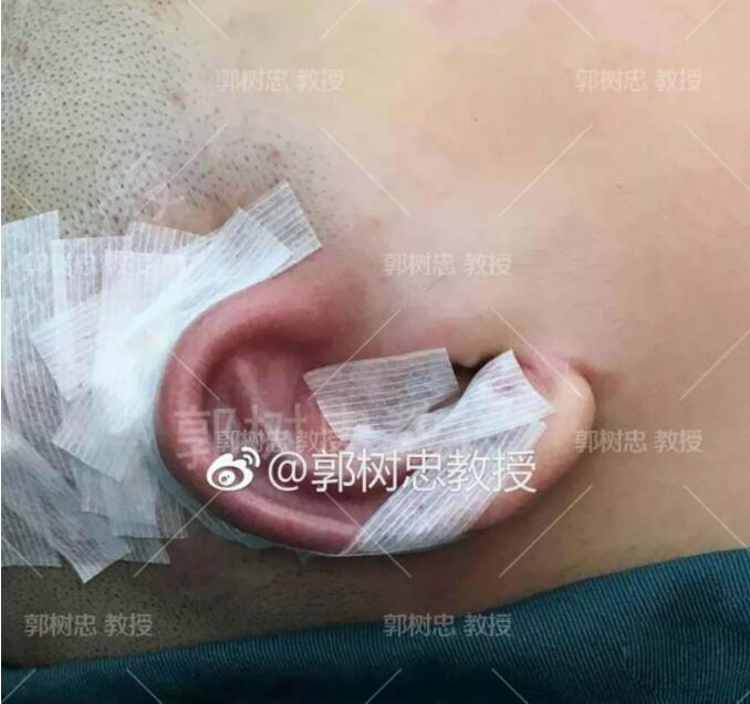 全耳再造手术分几期完成?我用我的实际情况来问你解答