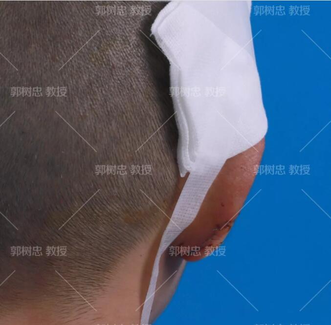 全耳再造手术分几期完成?我用我的实际情况来问你解答