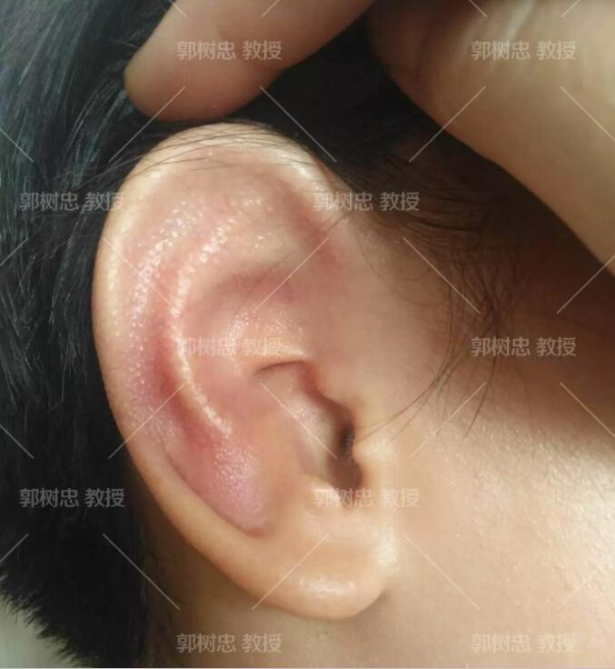 全耳再造手术分几期完成?我用我的实际情况来问你解答
