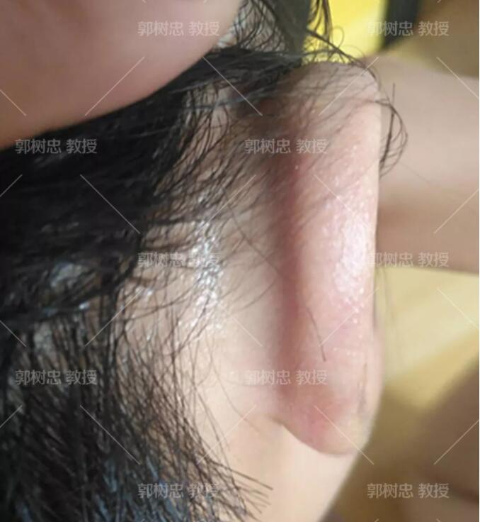 全耳再造手术分几期完成?我用我的实际情况来问你解答