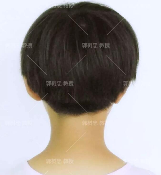 全耳再造手术分几期完成?我用我的实际情况来问你解答