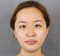 怎么改变鹰钩鼻子，通过鹰钩鼻子矫正逆天改命~ width=