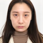 伊凡露除皱果如何?【内附Cecilia真实案例及果图】 width=