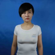 闺蜜晓梅在眉山华信医院3个月前做的假体隆胸，自信有气质了~ width=