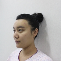 驼峰鼻修复价格多少?想了解的请转过脑袋看过来