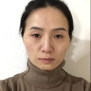 杨晓楠做的双眼皮，75天恢复让我成为素颜5分女孩~ width=