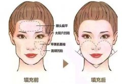 面部脂肪填充要多少钱呢 width=